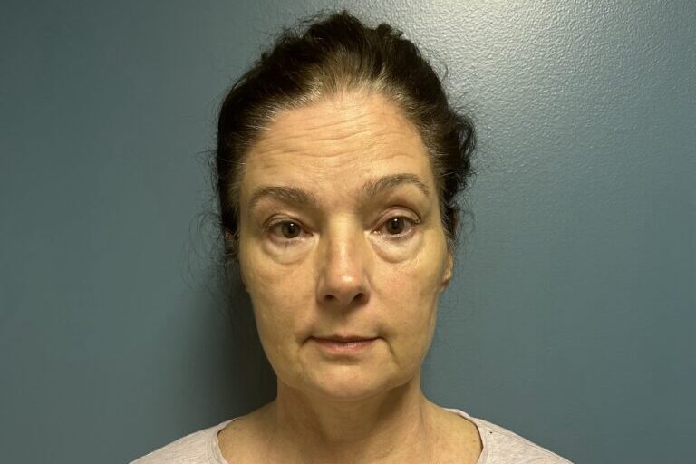 A patient's face before Emface skin tightening in Newburgh.