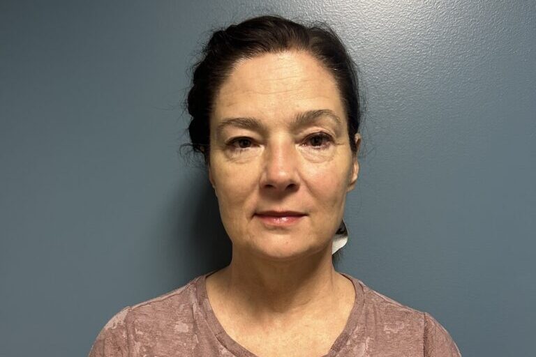 A patient's lifted, toned appearance after Emface skin tightening in Newburgh.